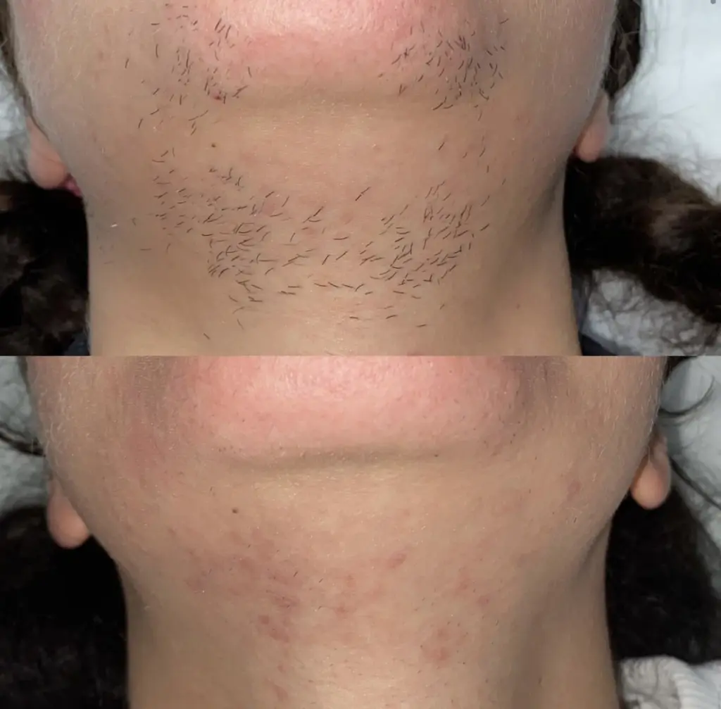 Laser for PCOS and Hormonal Hair