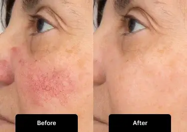 Thread Vein and Rosacea Removal
