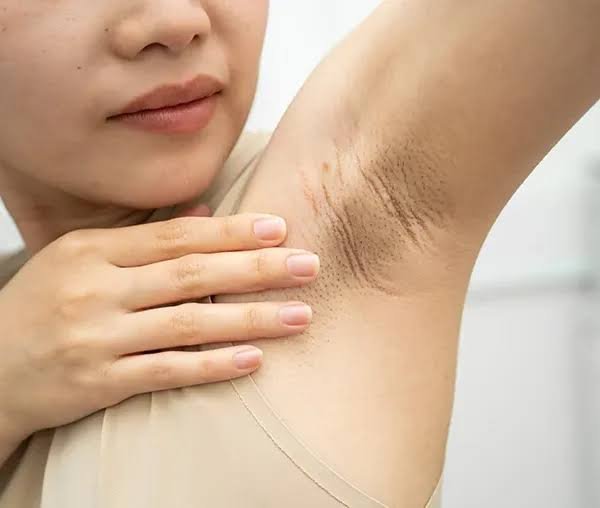 Underarms