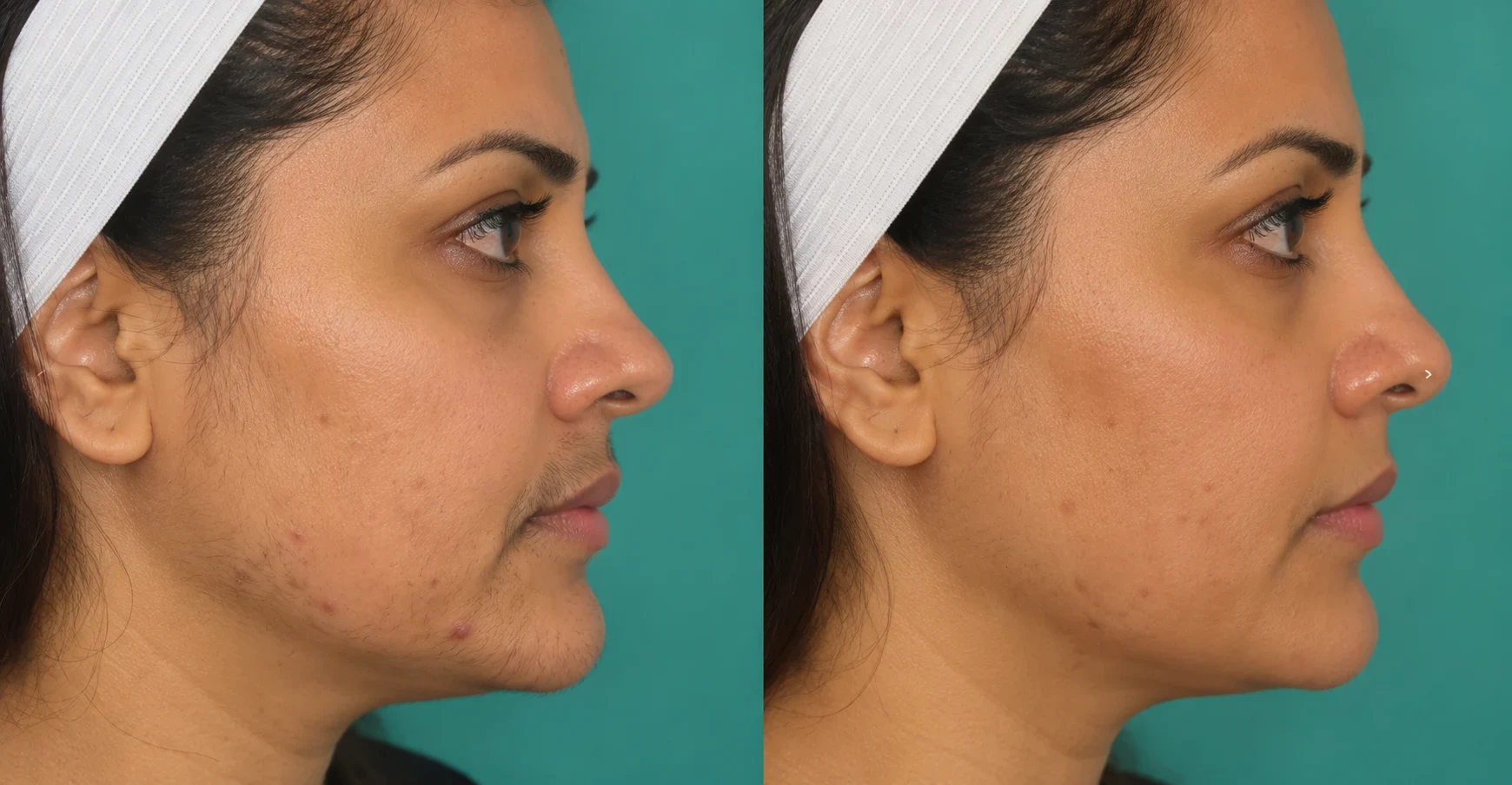Amira Upper Lip and Chin Sparkhill