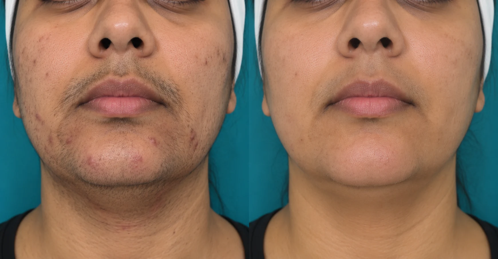 Saira Chin, Upper Lip and Jawline Moseley