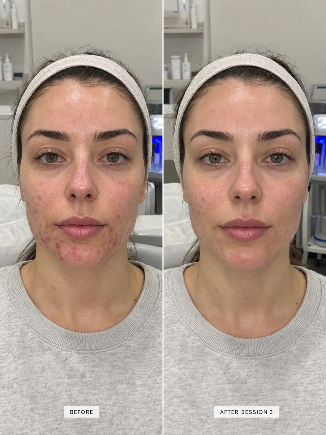 Case Study 2 Hormonal Acne