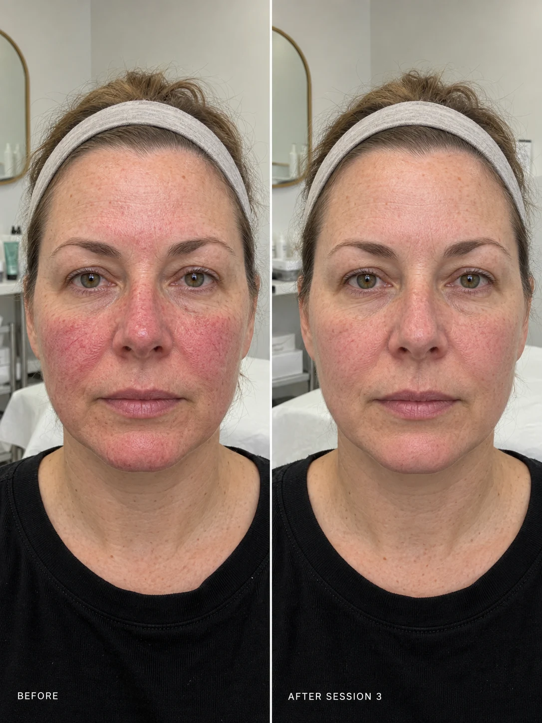 Rosacea Redness Client